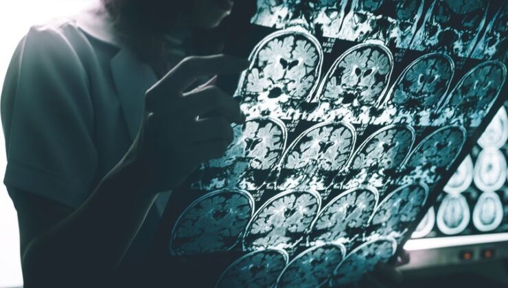 Alzheimer tedavisinde çığır açan ilaç: Hastalığı yavaşlattığı kanıtlandı